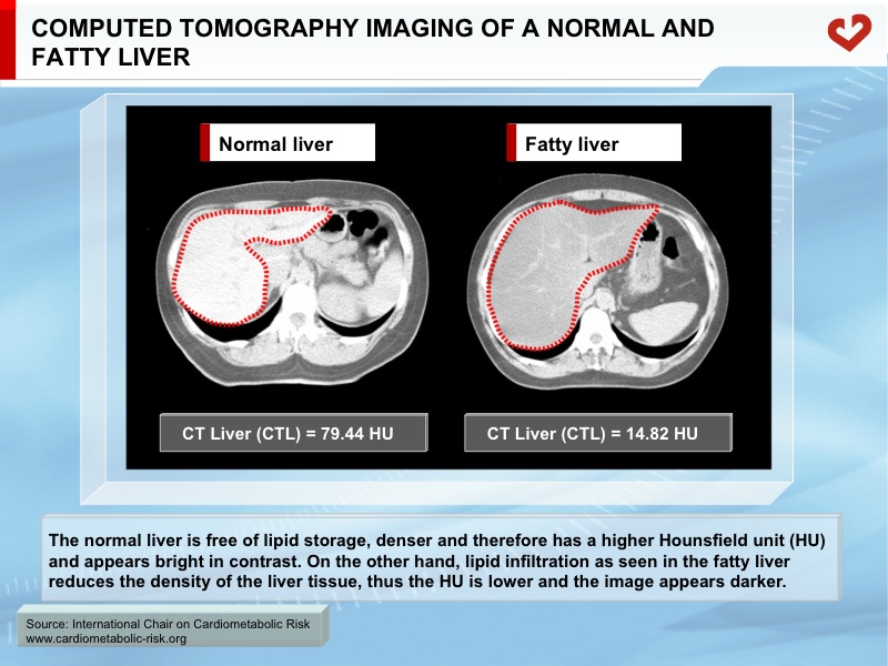 Computed tomography imaging of a normal and fatty liver