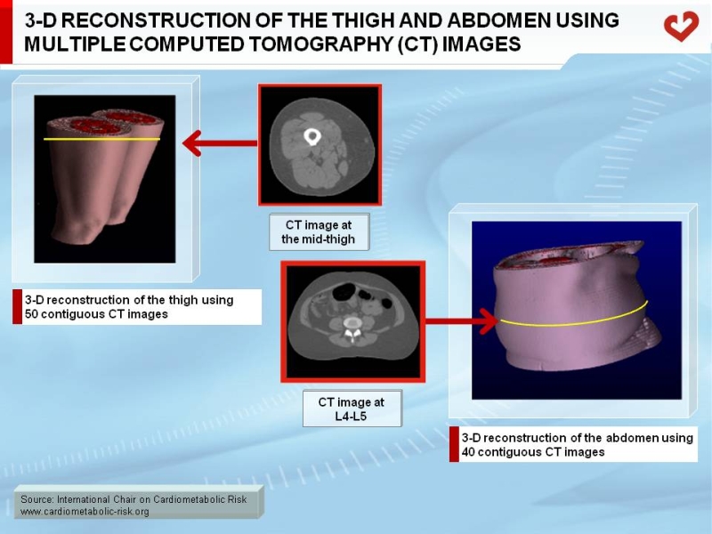 3-D reconstruction of the thigh and abdomen using multiple computed tomography (CT) images