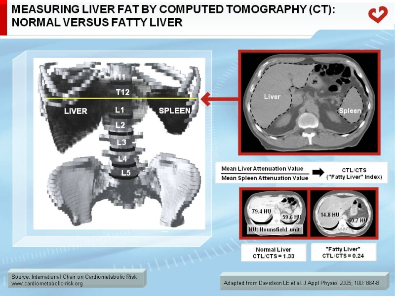 Measuring liver fat by computed tomography (CT): normal vs. fatty liver