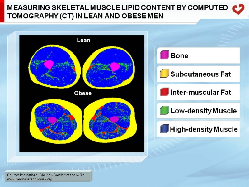 Measuring skeletal muscle lipid content by computed tomography (CT) in lean and obese men