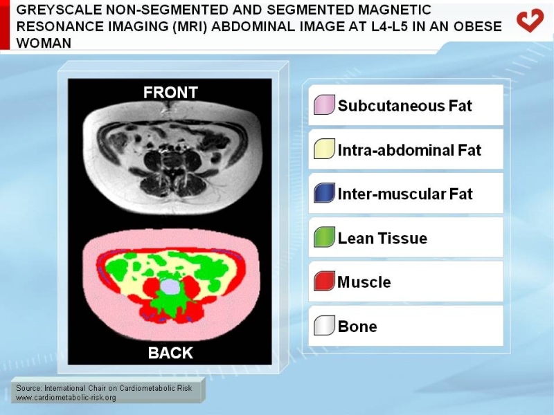 Greyscale non-segmented and segmented magnetic resonance imaging (MRI) abdominal image at L4-L5 in an obese woman
